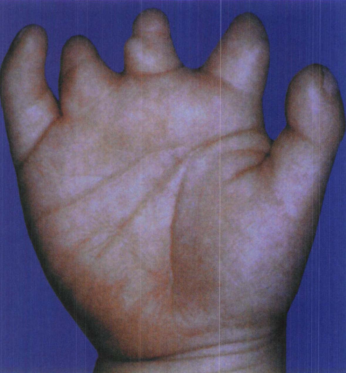 图1-30 短指畸形